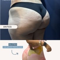 Resultado glúteo